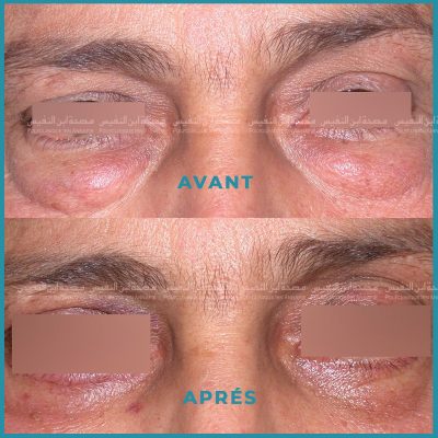 Bl Pharoplastie Polyclinique Ibn Annafis